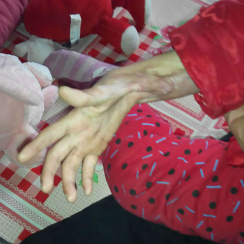 妤心植皮后，出現(xiàn)了非常嚴(yán)重的疤痕增生現(xiàn)象